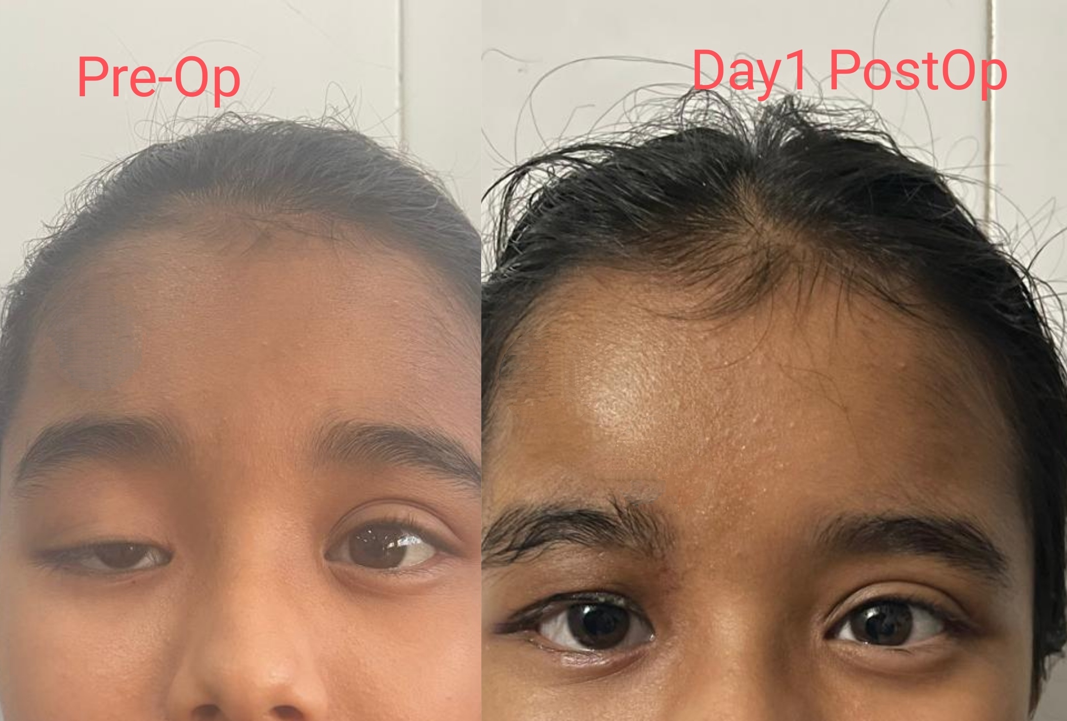 Cataract Surgery