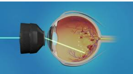 Cataract Surgery