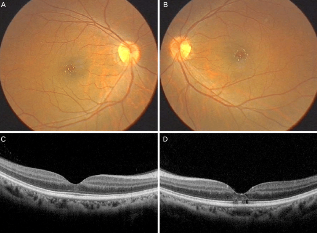 Cataract Surgery